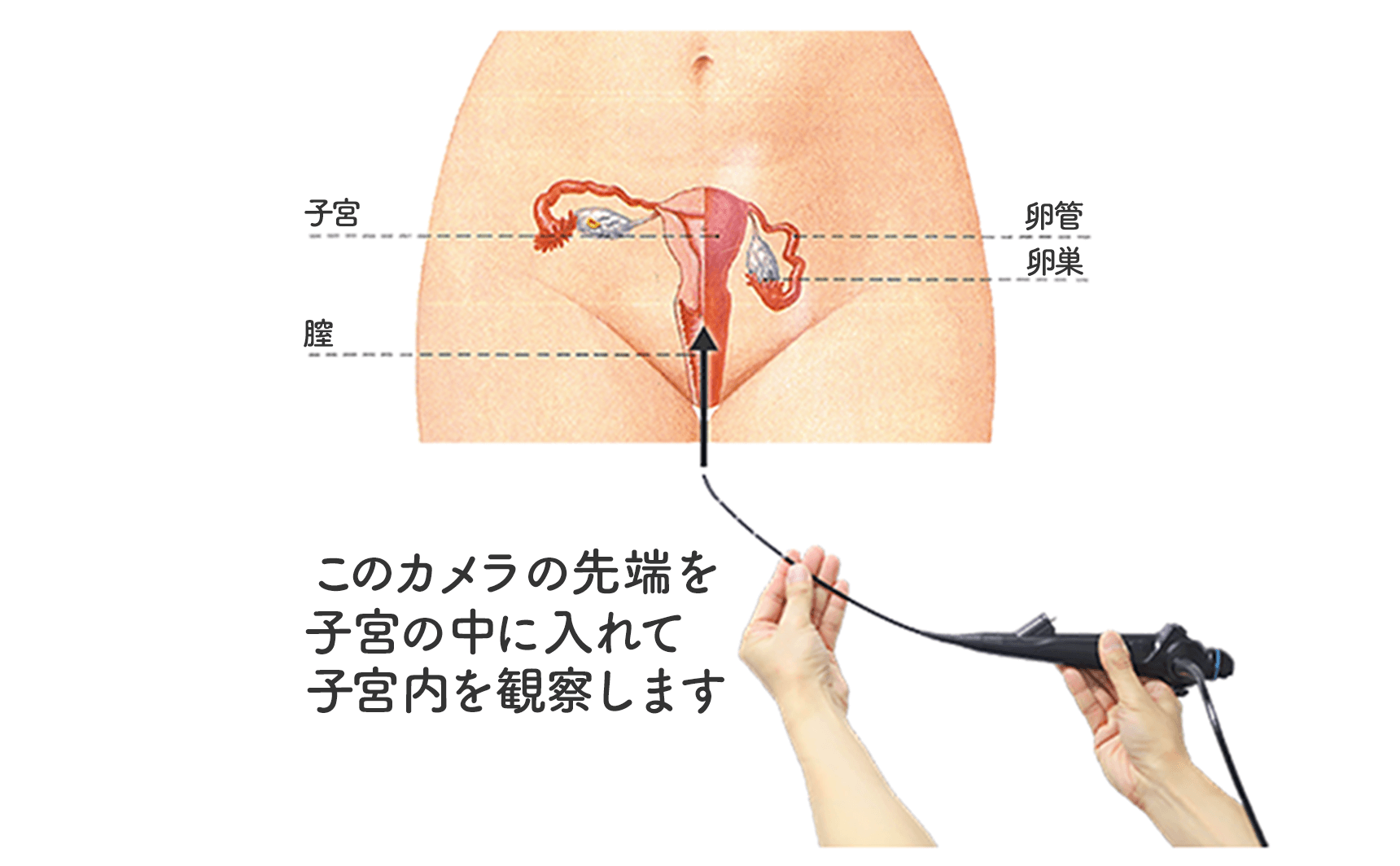 子宮鏡検査 子宮の中に細いカメラを入れて、子宮の中を直接観察する検査です。受精卵が着床する子宮の中を観察することはとても大切です。 妊娠率が下がるといわれている、子宮内膜ポリープ、子宮内膜炎の有無を検査します。また卵の通り道である卵管口が閉塞していないかどうかも確認します。 これら妊娠の妨げになる異常所見の有無を、治療早期から確認することで、より早く妊娠に近づきます。 当院では妊娠希望の患者さん全員に受けていただくことができます。