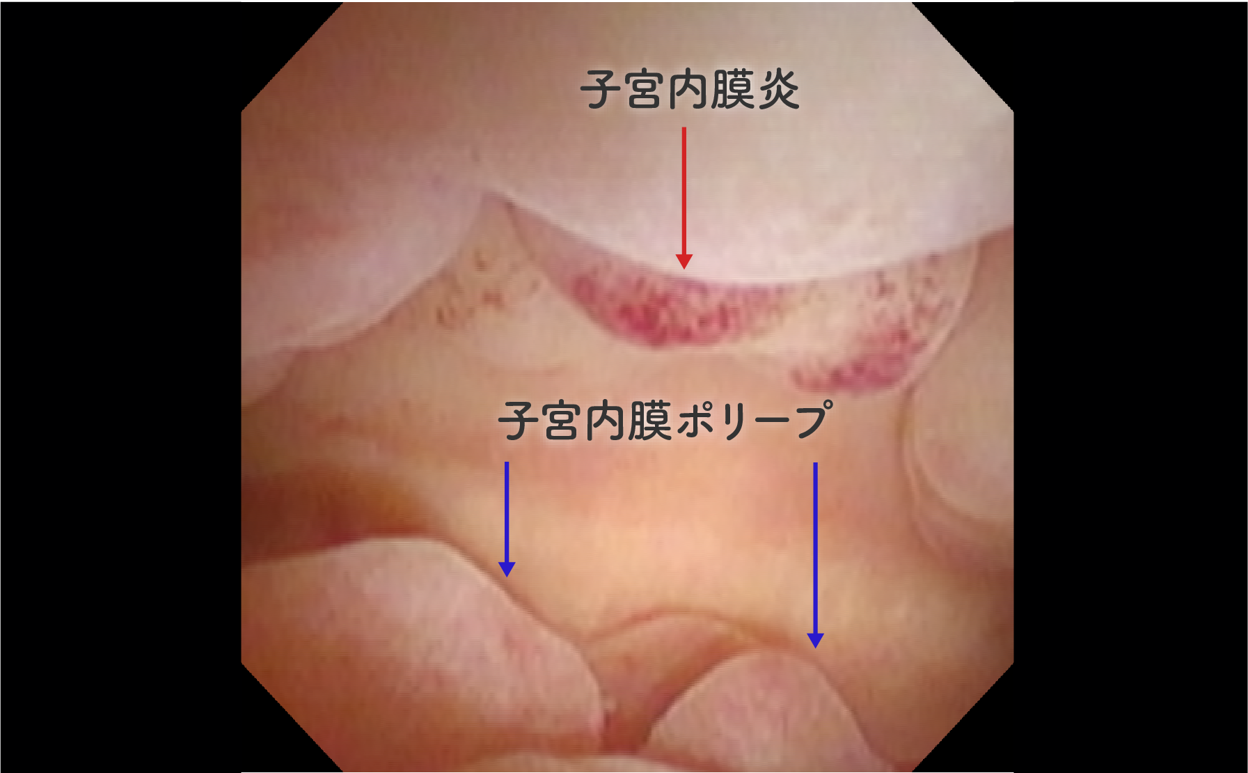 子宮内膜ポリープが存在している内腔 突出しているのがポリープで(青矢印)、赤い表面は内膜炎(赤矢印)を併発しています。