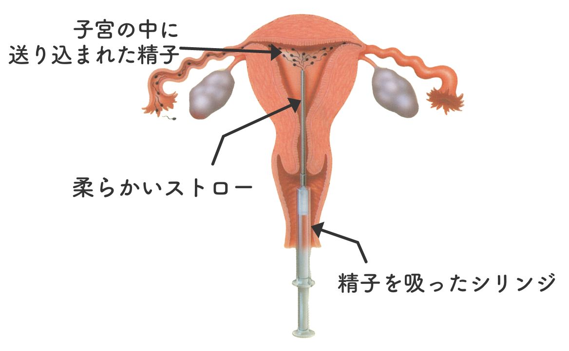 人工授精（AIH）とは？排卵日にご主人から預かった精子を柔らかいストローを使って子宮の中まで精子を届けます。