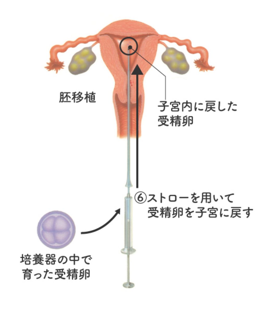 体外受精の手順⑥ 育った受精卵はストローを用いて子宮に戻す(移植)