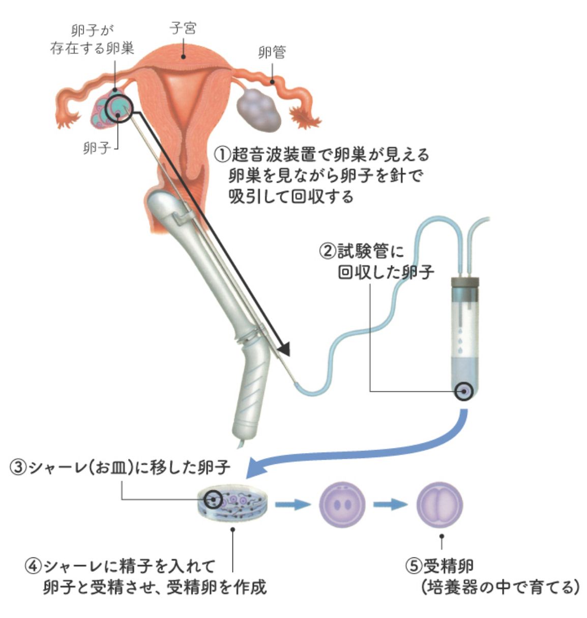 体外受精の手順① 超音波で卵巣を診る ② 卵子を採取する針を卵巣に進め、卵子を吸引し、試験管の中に回収する(採卵) ③ 卵子をシャーレに移す ④ シャーレに精子を入れ、卵子と精子を受精させる ⑤ 受精卵を培養器の中で5日間育てる